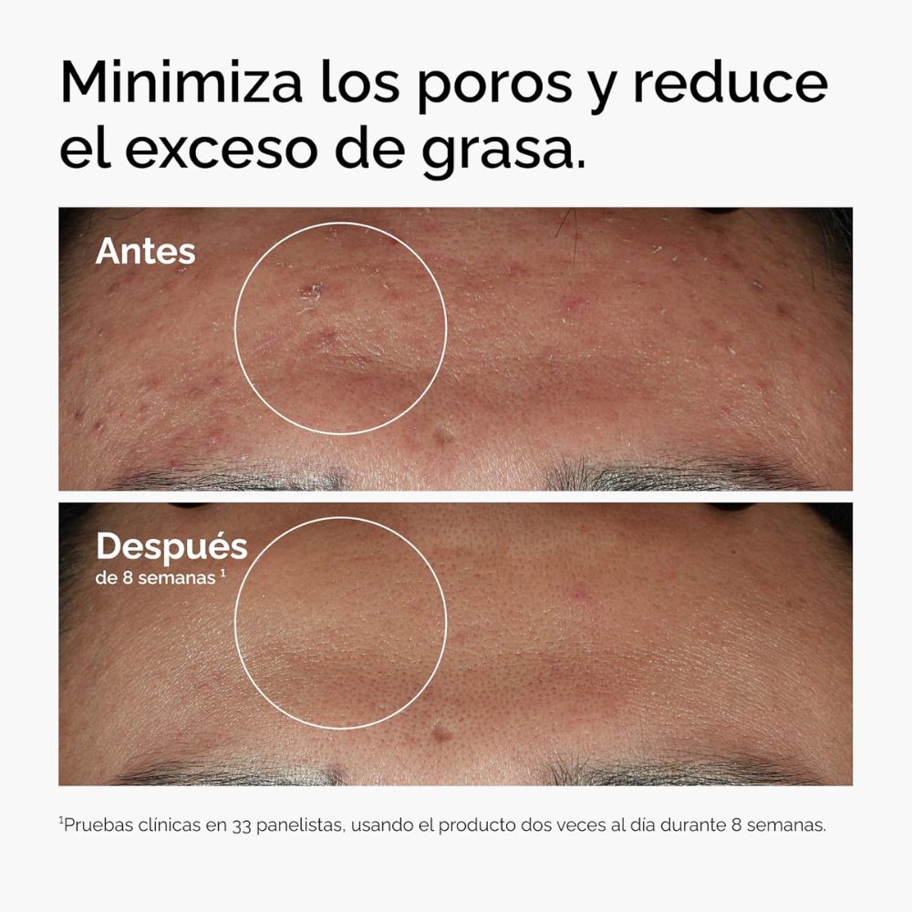 NIACINAMIDE 10% + ZINC 1% (S&Eacute;RUM ANTI-IMPERFECCIONES Y CONTROL DE POROS)